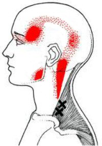 Try Myofascial Triggers Points for Migraine Headache Relief