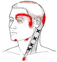 Myofascial Trigger Points: Relief for Tension Headache